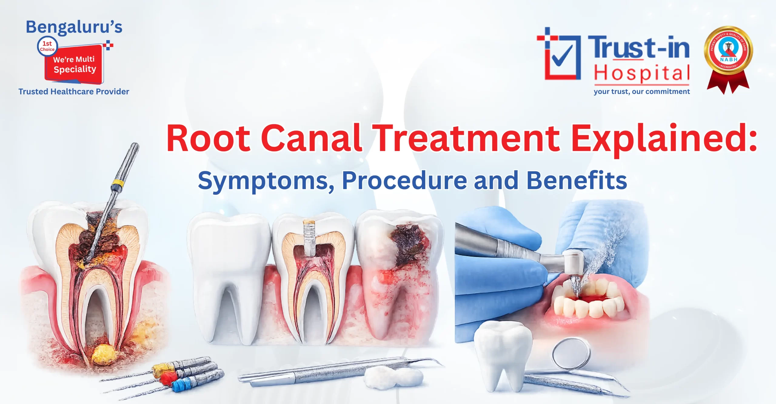 Root Canal Treatment | Trust-In Hospital